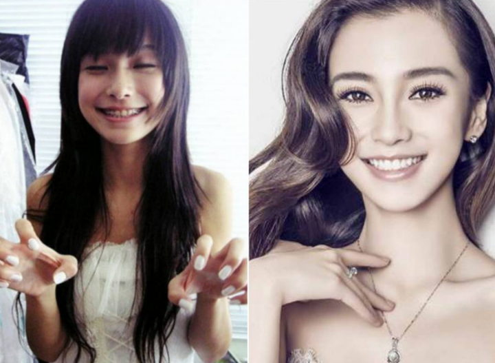 明星牙齿矫正之旅，带牙套全攻略与矫正之旅揭秘