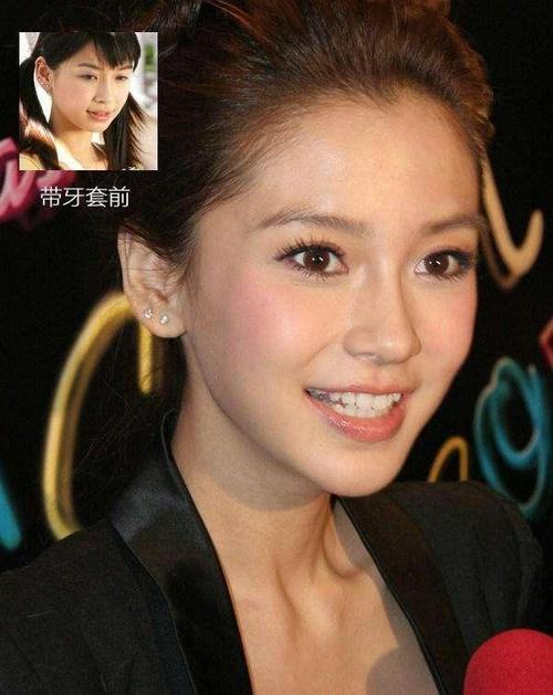 明星牙齿矫正之旅，带牙套全攻略与矫正之旅揭秘