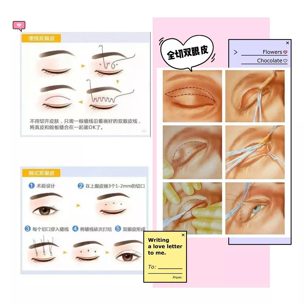 双眼皮手术新法揭秘，小明的变身之旅与友情的纽带