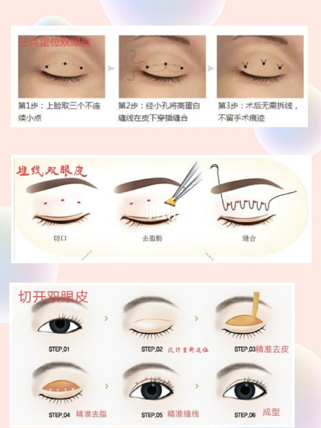 双眼皮手术新法揭秘，小明的变身之旅与友情的纽带