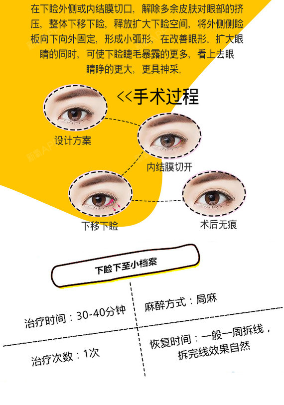 双眼皮手术新法揭秘，小明的变身之旅与友情的纽带
